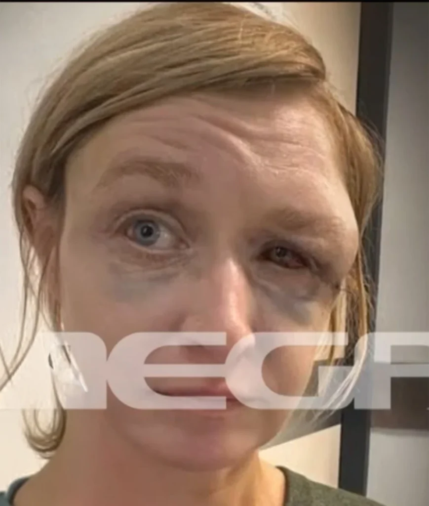 Σοκ στο Κορωπί: Η 40χρονη Λιθουανή που ξυλοκοπήθηκε μιλά για πρώτη φορά – «Ήταν σχέση αγάπης» 2 Κορωπί