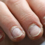 Εύθραυστα νύχια που δείχνουν σημάδια φθοράς