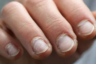 Εύθραυστα νύχια που δείχνουν σημάδια φθοράς