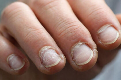 Εύθραυστα νύχια που δείχνουν σημάδια φθοράς