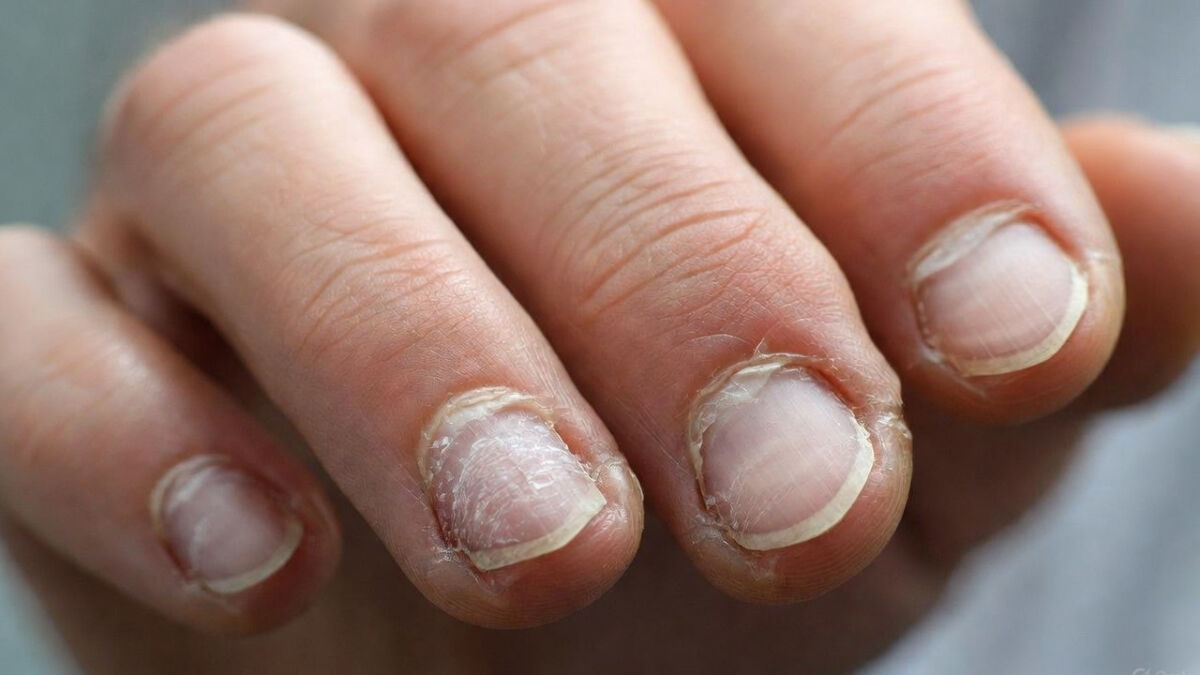 Εύθραυστα νύχια που δείχνουν σημάδια φθοράς